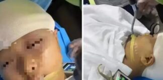 Garota de 9 anos tem crânio quebrado por professora com régua de metal; cérebro quase ‘pulou’