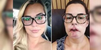 Mulher perde lábio superior após harmonização facial feita em troca de divulgação