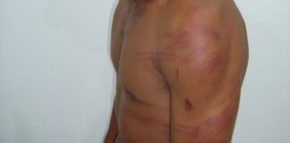 Jovem é atacado com socos e mordidas pelo companheiro enciumado