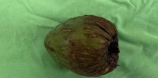 Homem é operado de emergência após inserir coco no corpo para estimulação sexual