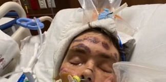 Homem entra em coma após tentar retirar pelo encravado de virilha