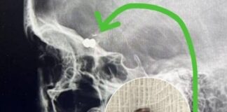 BALA ALOJADA: Menina de 10 anos é atingida com tiro na cabeça; vizinhos são suspeitos