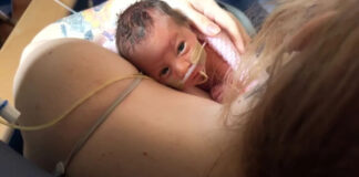 Bebê nasce com órgãos expostos e sobrevive com auxílio de filme PVC