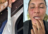 Mulher vítima de violência doméstica tem parte da língua cortada pelo marido