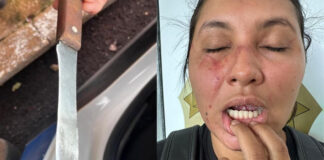Mulher vítima de violência doméstica tem parte da língua cortada pelo marido