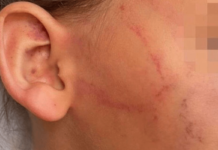 Mãe é suspeita de morder a filha no rosto após a criança urinar na roupa