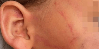 Mãe é suspeita de morder a filha no rosto após a criança urinar na roupa