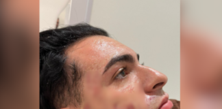 Peeling: empresário tem como principal causa de morte um “edema pulmonar agudo”