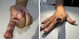 Violência por ciúmes: Homem morde e arranca parte do dedo da namorada em Manaus