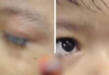 Criança de 2 anos é encontrada com olhos “colados” no Amazonas