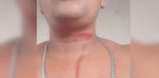 Perigo: Linha de cerol causa diversos ferimentos em jovem na zona sul de Manaus